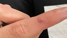 آبله میمون انگشت