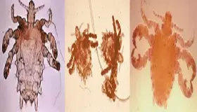 عکس شپش ناحیه تناسلی از نزدیک