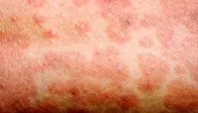 عکس سرخک 3