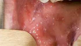 عکس سرخک 2