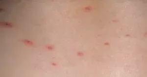 عکس دانه های آبله مرغان