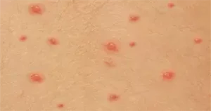 عکس مرحله اول آبله مرغان